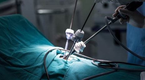 Laparoscopy