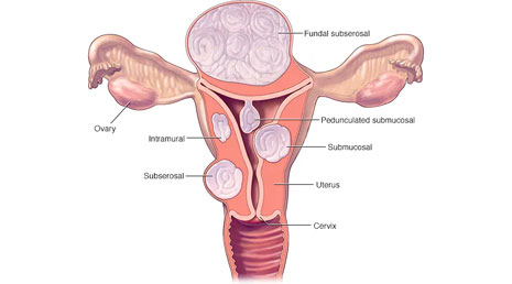 Fibroids