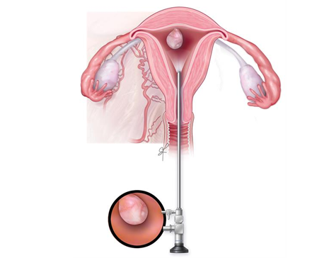 Hysteroscopy