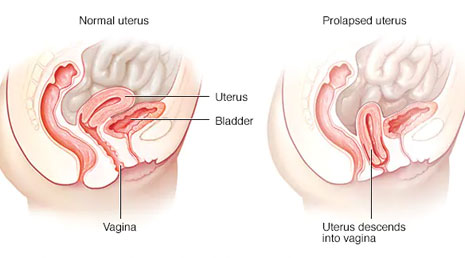 Prolapse